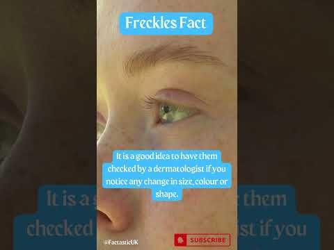 Discover the Surprising Truth About Freckles: What They Are and Why Fair-Skinned People Get Them!